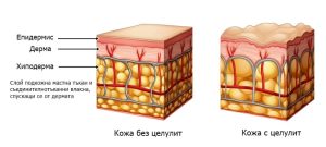 схема на кожа с целулит